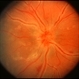 Possible CMV Retinitis with Frosted Branch Angiitis